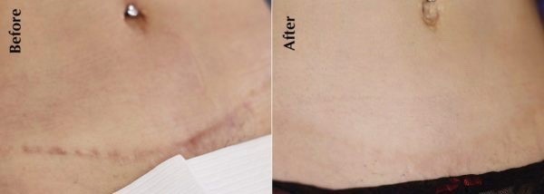 Tummy Tuck Scar Camouflage  Most Popular Treatments