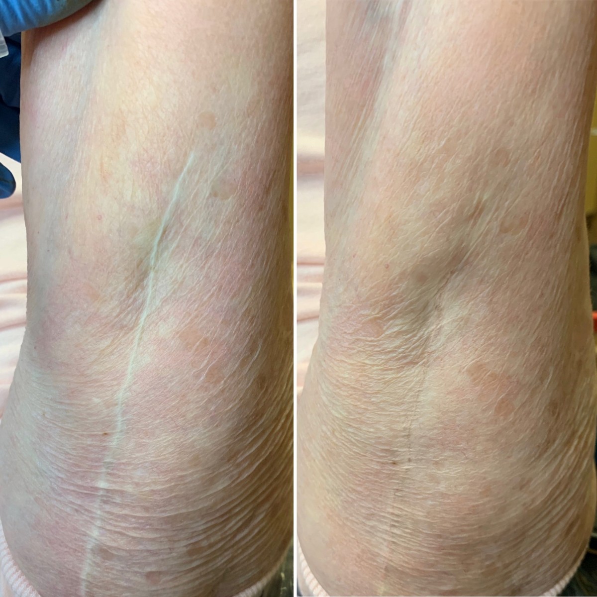 Brachioplasty Arm Lift Before and After Photos  Graham Plastic Surgery
