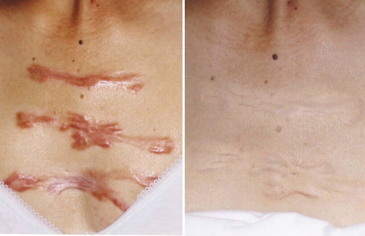 Scar Camouflage in Baltimore area | Glow Cosmetic Tattoo Studio