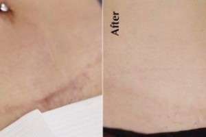 Tummy Tuck Scar Camouflage - Most Popular Treatments