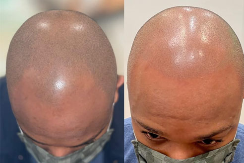 Scalp Micro-pigmentation